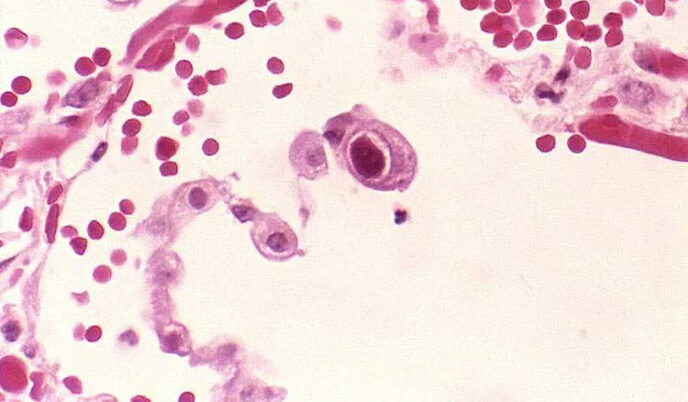 Cell under a microscope shows enlarged nuclei characteristic of cytomegalovirus